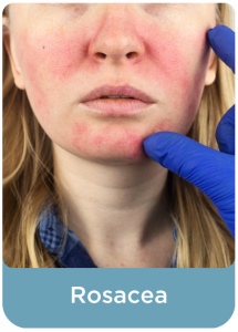 Rosacea